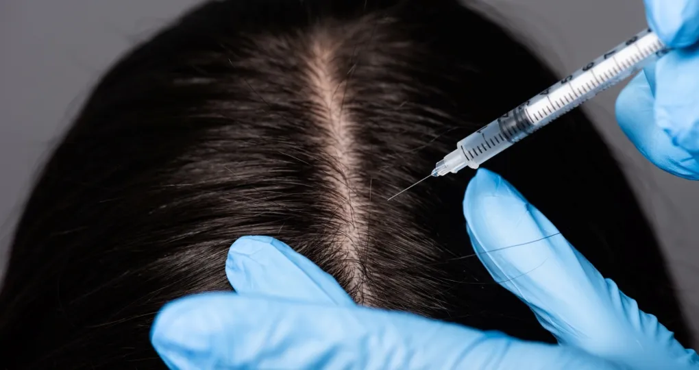 Mezoterapia iniekcyjna- stymulacja wzrostu włosów