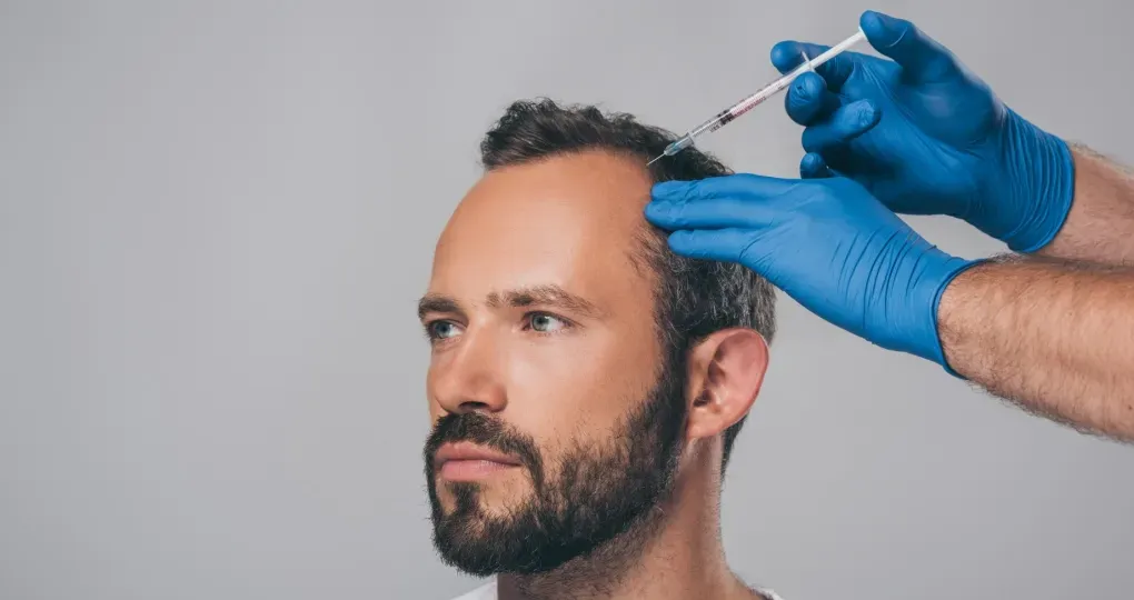Łysienie androgenowe – mezoterapia igłowa skóry głowy